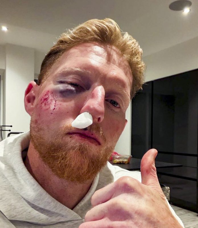 Ben Stokes suffers facial injury